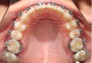 oclusal superior
