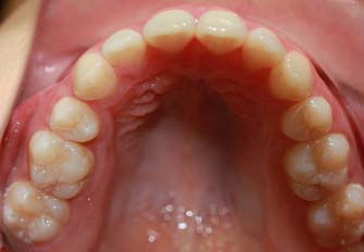 Oclusal Superior