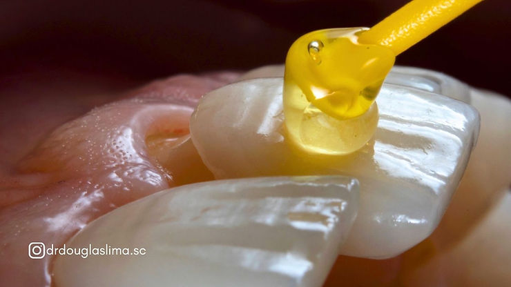 faceta dental Dr Douglas Lima