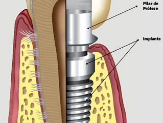 O que é o Implante Dental