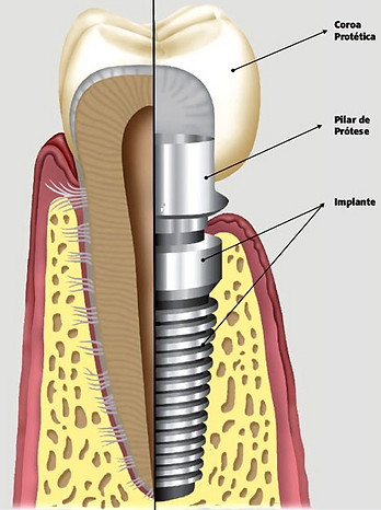 O que são os implantes dentais