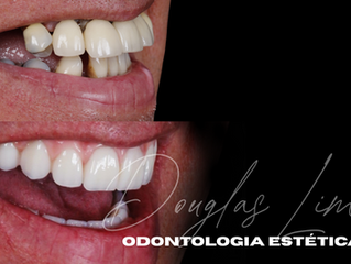 Protocolo em acrílico Dr Douglas Lima