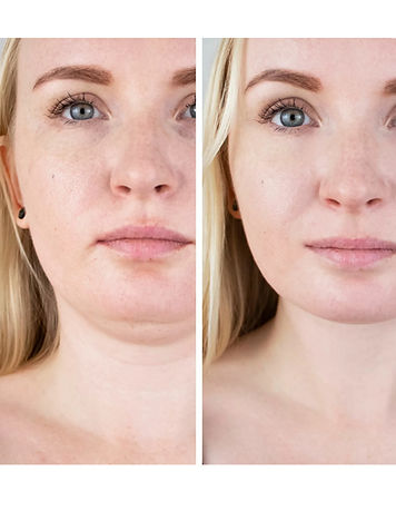 No Surgery Face Lift before&after