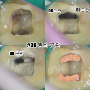 부산신경치료 잘하는곳 미세현미경의 중요성