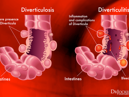 DIVERTICULITIS