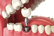 Single Dental Implant, Dental Implact, Limerick Dental Implants, Demonstration of Dental Implant, Single tooth replacement, Tooth repair, digital image of single implant