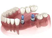 multiple teeth implants, dental implants, multiple teeth replacement, multiple teeth removal, implants, dental bridges, missing teeth repair, missing teeth, digital example of teeth replacement, denture alternative