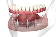 All on X implant, full arch dental implant, all teeth dental implant, denture alternative, full teeth repairment, full teeth replacement, implant supported dentures, permanent teeth, all on X digital image