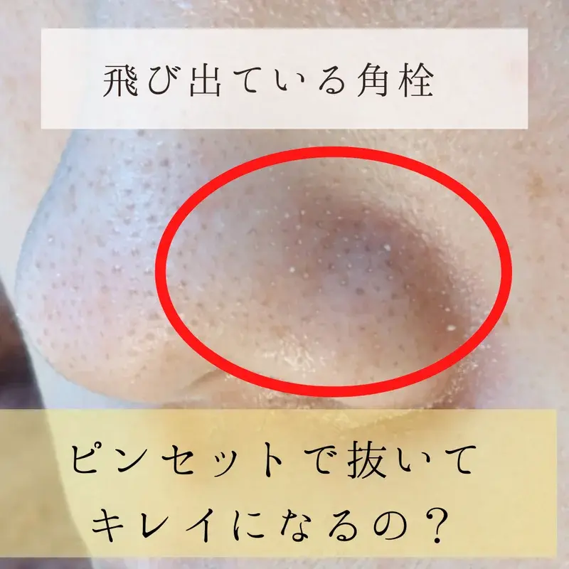 飛び出ている角栓