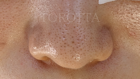 意外と知らない毛穴黒ずみの話