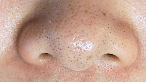 鼻の黒ずみ、顔脱毛、産毛黒ずみ毛穴