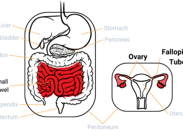 Study Suggests HIPEC During Surgery May Lower Risk of Bowel Obstruction in Ovarian Cancer