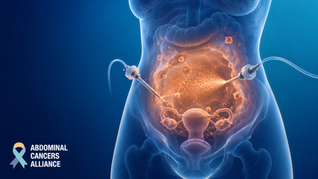 Transparent blue torso shows glowing abdominal cancer being treated by two probes; Abdominal Cancers Alliance logo.
