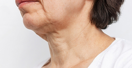 Nefertiti Lift Explained: Botox for Neck Tightening and Jawline Perfection