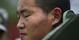 Botox for Hyperhidrosis: A Solution for Excessive Sweating