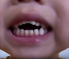 Close-up of a child's mouth showing signs of an open bite, a common dental issue often linked to prolonged thumb or pacifier sucking, recently highlighted on social media platforms like TikTok but known for decades.