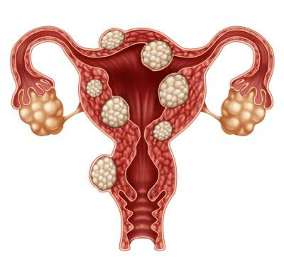 Destigmatizing Endometriosis