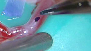 バイパス手術の動脈切開のtips