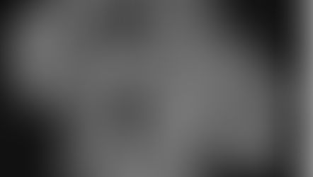 脳動静脈奇形(AVM)の手術