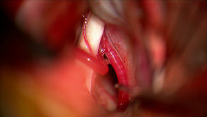 高齢者の方が三叉神経痛の手術成績が良い？