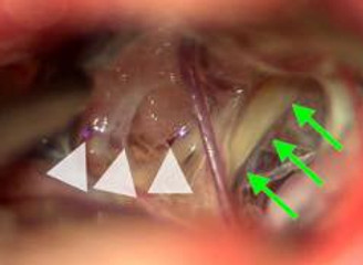 三叉神経痛,脳腫瘍,髄膜腫