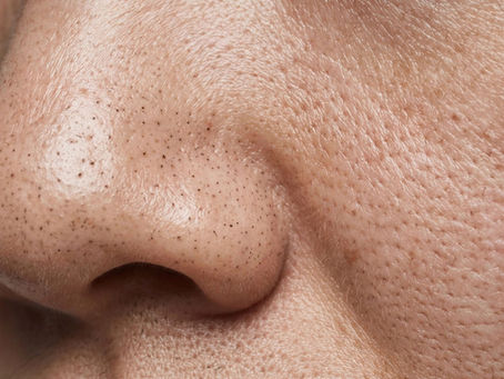 Blackheads vs. Sebaceous Filaments: How to Tell the Difference