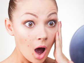 How to Get Rid of Acne?