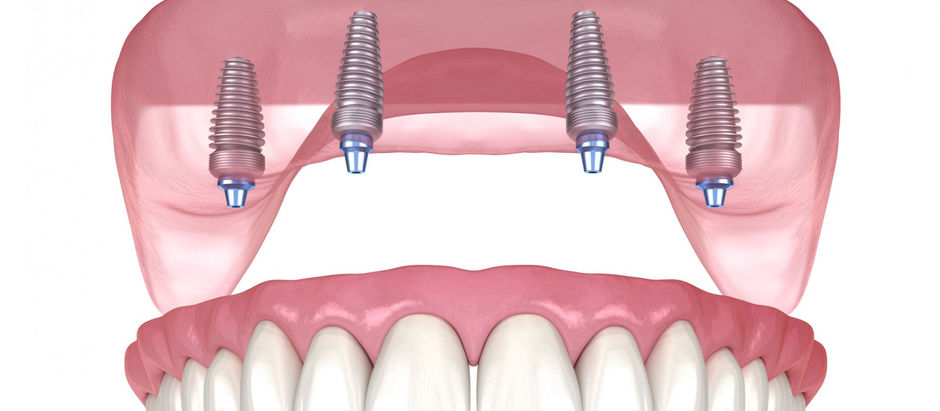 How to Enjoy the Benefits of All-on-4 Dental Implants