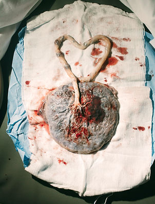 placenta with umbilical cord shaped as a heart