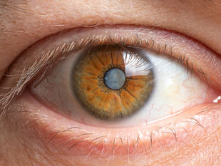 Everything You Need To Know About Cataracts
