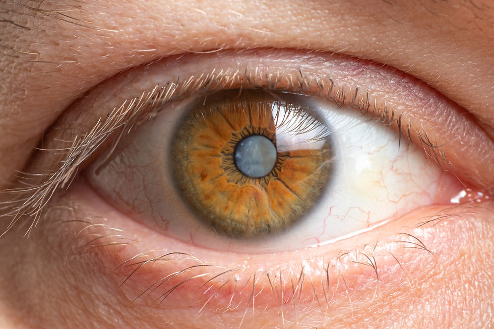 Cataracts in an eye