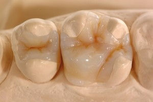 Composite Restorations