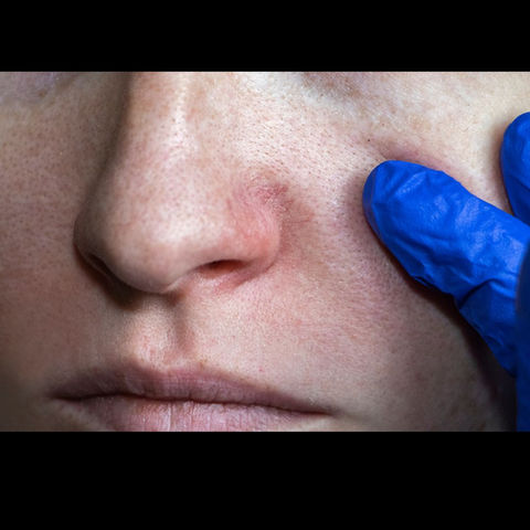 red thread vein removal