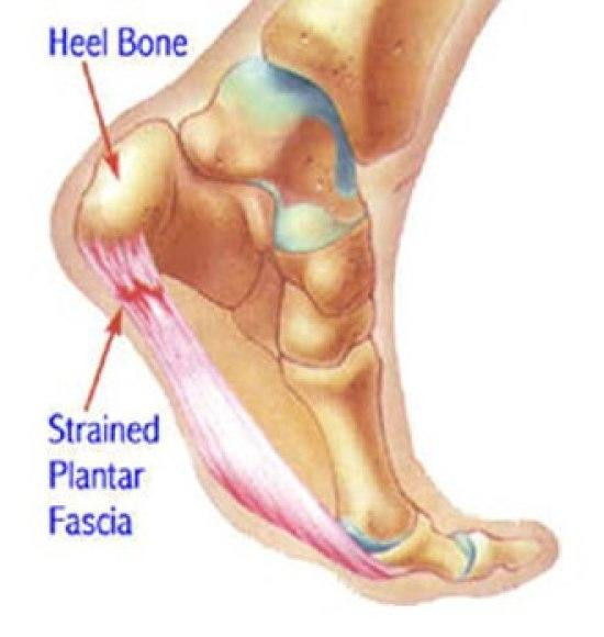 pain in the heel