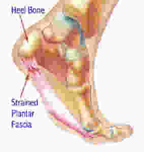 pain in the heel