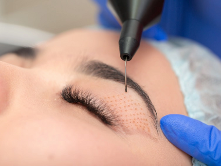 What is the Success Rate of Plasma Pen Treatment?