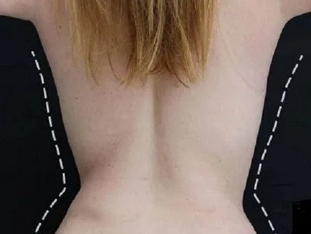 Guide to Complete Body Sculpting with 360 Lipo