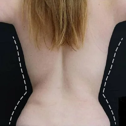 Guide to Complete Body Sculpting with 360 Lipo