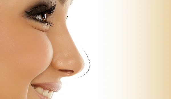 Is Rhinoplasty worth it?