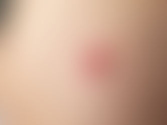 Warts Removal Surgery for All Skin Types