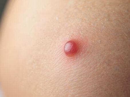 Warts Removal Surgery for All Skin Types