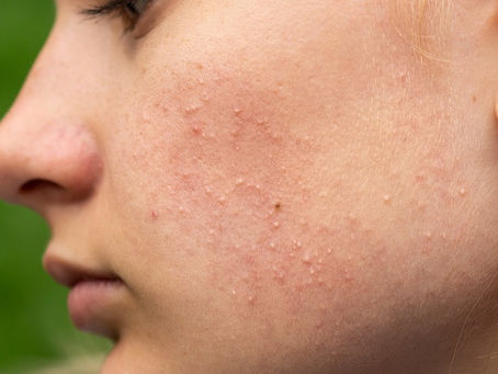 Can adults undergo Acne Treatment?