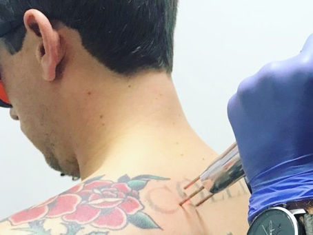 What is the Success Rate of Laser Tattoo Removal