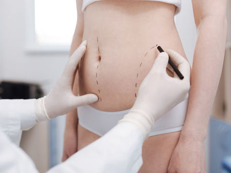 Can Liposuction Help With Weight Loss?