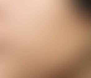 Facial Scar Revision: Perfect Your Skin, Boost Your Confidence