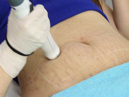 Can Stretch Marks Be Removed Permanently