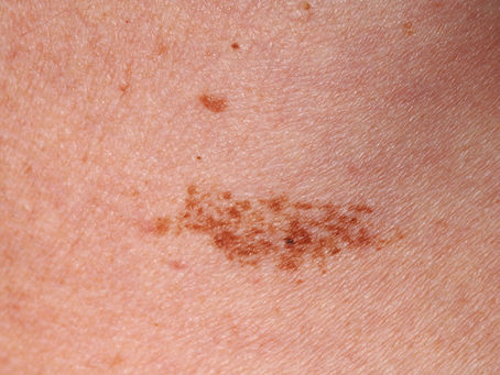 Birthmark Removal Treatments for All Skin Types Dubai