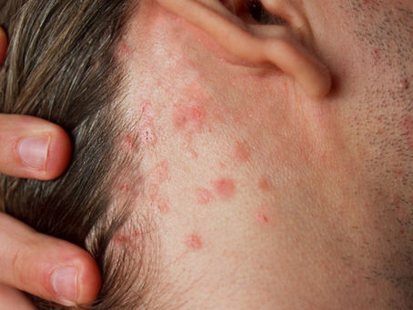 Can a dermatologist treat scalp eczema using lasers