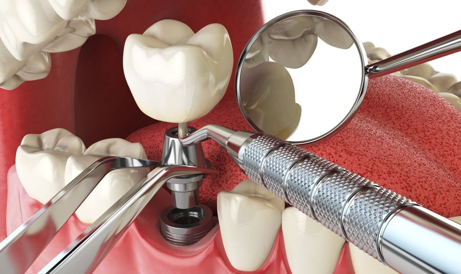 Dental Implants Before and After Results Explained