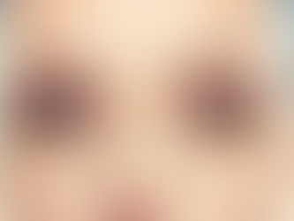 Do Dark Circles Get Worse With Age?